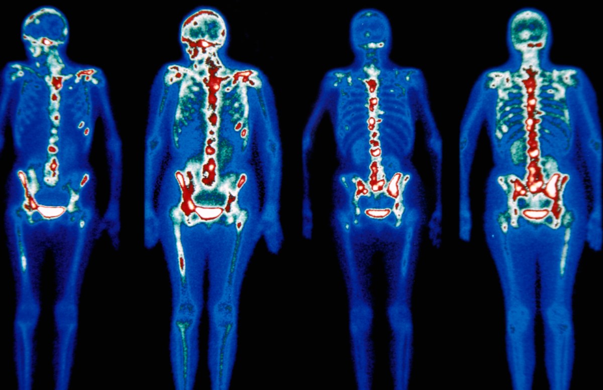 scientists-discovered-how-cancer-spreads-and-how-to-slow-it-insidehook