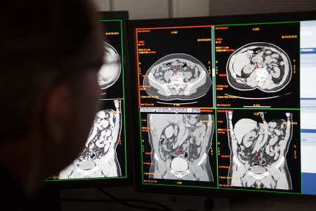 Scientist looking at CT scan. A new clinical trial is looking at whether the key to treating long COVID can be found in the gut.