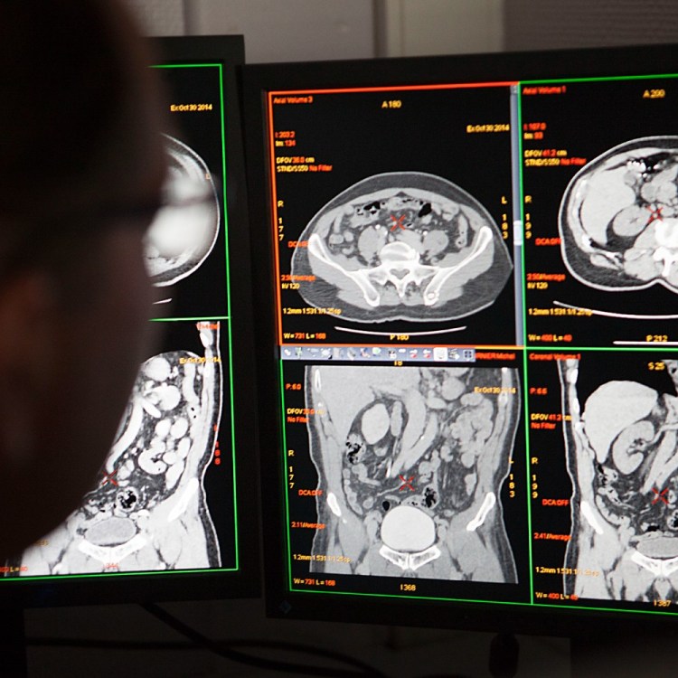 Scientist looking at CT scan. A new clinical trial is looking at whether the key to treating long COVID can be found in the gut.