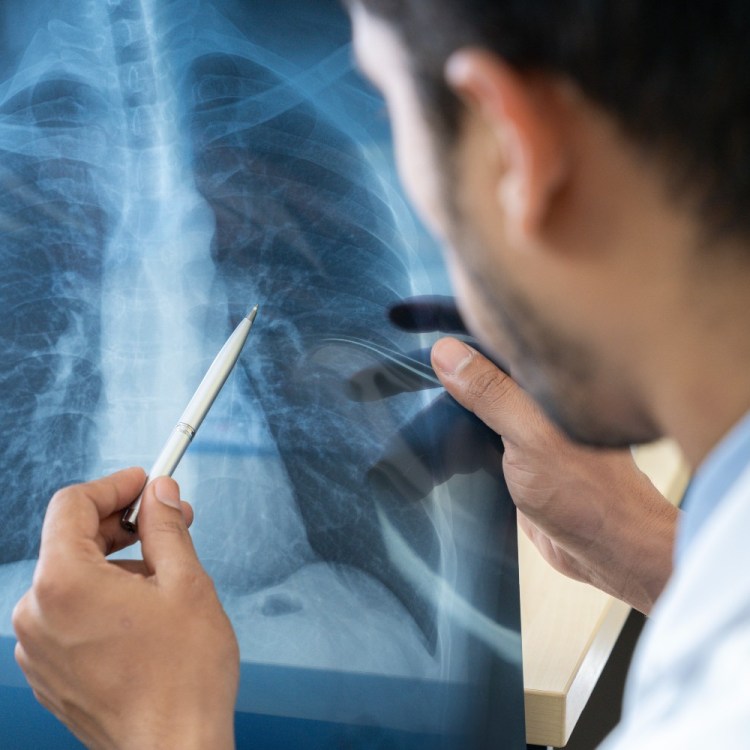 Doctor looking at a chest x-ray